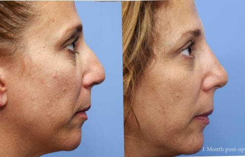 Rhinoplasty Before & After Gallery - Patient 58213322 - Image 2