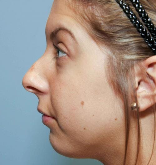 Rhinoplasty Before & After Gallery - Patient 58213323 - Image 1