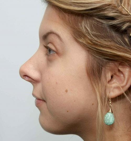 Rhinoplasty Before & After Gallery - Patient 58213323 - Image 2