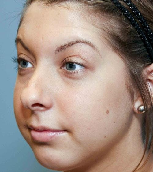 Rhinoplasty Before & After Gallery - Patient 58213323 - Image 3