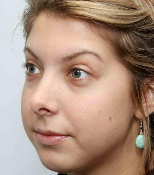 Rhinoplasty Before & After Gallery - Patient 58213323 - Image 4