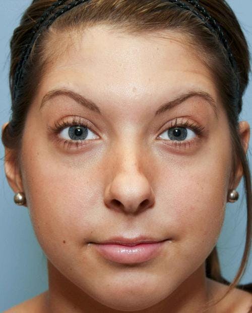 Rhinoplasty Before & After Gallery - Patient 58213323 - Image 5