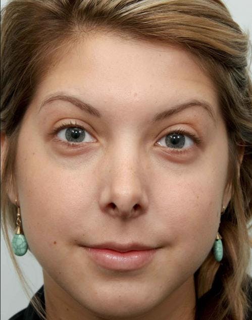 Rhinoplasty Before & After Gallery - Patient 58213323 - Image 6