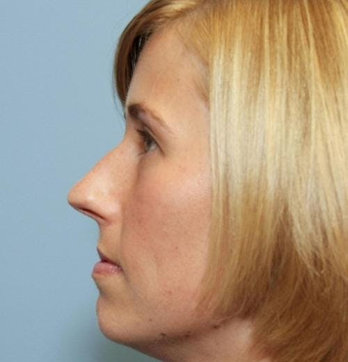 Rhinoplasty Before & After Gallery - Patient 58213324 - Image 1