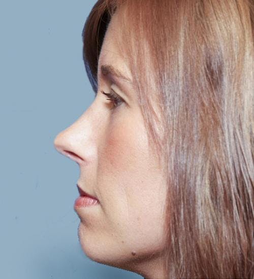 Rhinoplasty Before & After Gallery - Patient 58213324 - Image 2