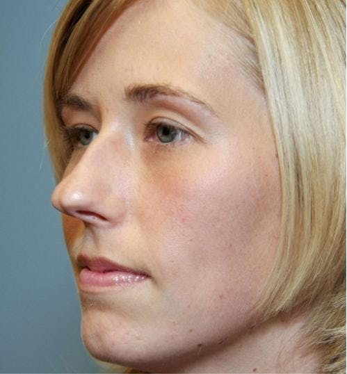 Rhinoplasty Before & After Gallery - Patient 58213324 - Image 3