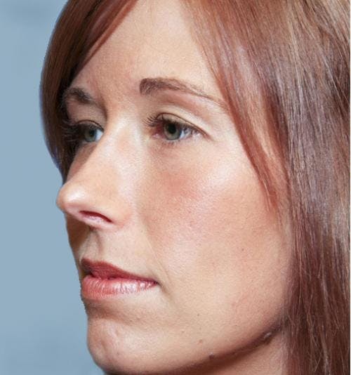 Rhinoplasty Before & After Gallery - Patient 58213324 - Image 4