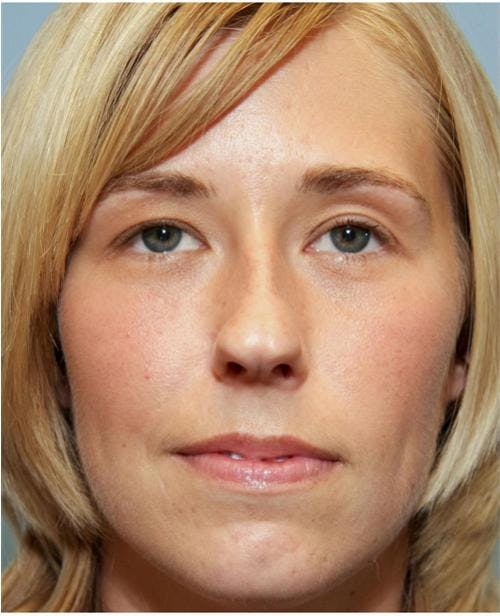 Rhinoplasty Before & After Gallery - Patient 58213324 - Image 5