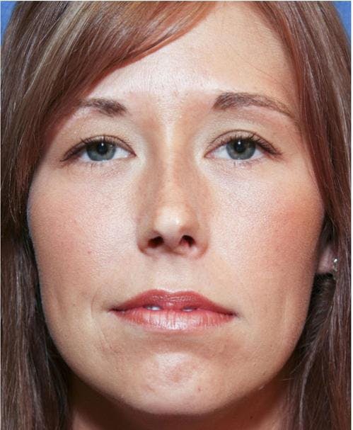 Rhinoplasty Before & After Gallery - Patient 58213324 - Image 6
