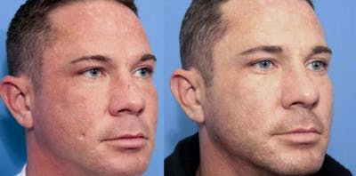 Scar Revision Before & After Gallery - Patient 253218 - Image 1