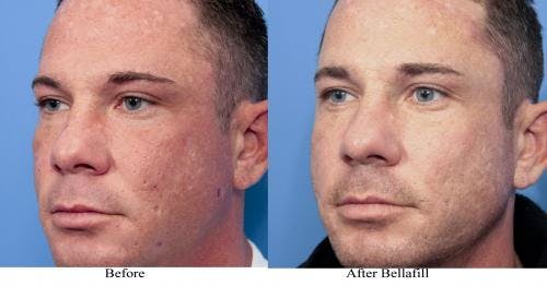 Scar Revision Before & After Gallery - Patient 58214142 - Image 2