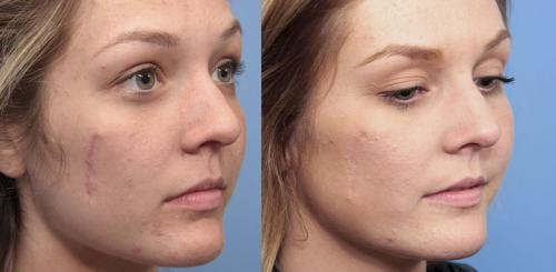 Scar Revision Before & After Gallery - Patient 58214143 - Image 1