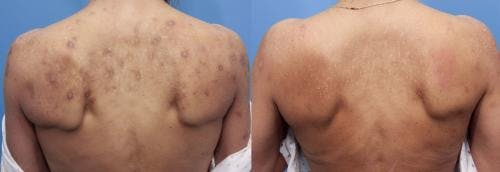 Scar Revision Before & After Gallery - Patient 58214145 - Image 1