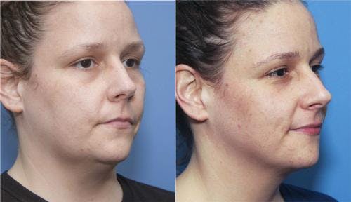 Kybella Before & After Gallery - Patient 58214179 - Image 1