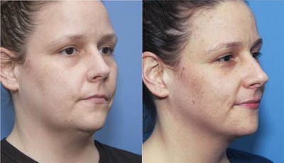 Kybella Before & After Gallery - Patient 58214179 - Image 1