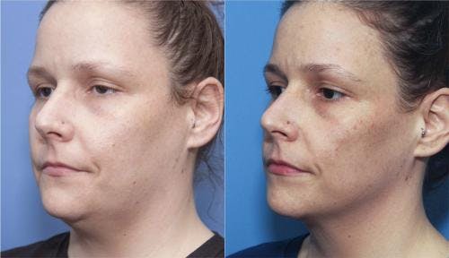 Kybella Before & After Gallery - Patient 58214179 - Image 2