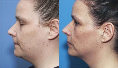 Kybella Before & After Gallery - Patient 58214179 - Image 3