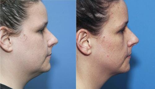 Kybella Before & After Gallery - Patient 58214179 - Image 4