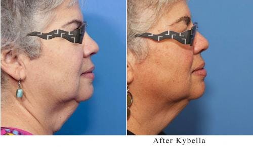 Kybella Before & After Gallery - Patient 58214181 - Image 1