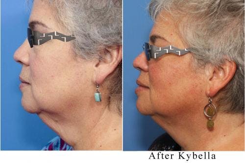 Kybella Before & After Gallery - Patient 58214181 - Image 2