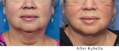 Kybella Before & After Gallery - Patient 58214181 - Image 3