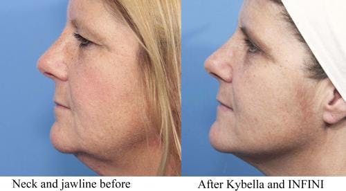 Kybella Before & After Gallery - Patient 58214182 - Image 1