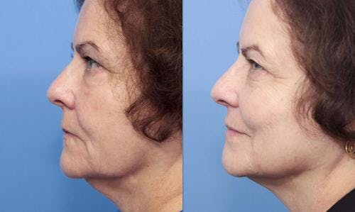 Kybella Before & After Gallery - Patient 58214184 - Image 1