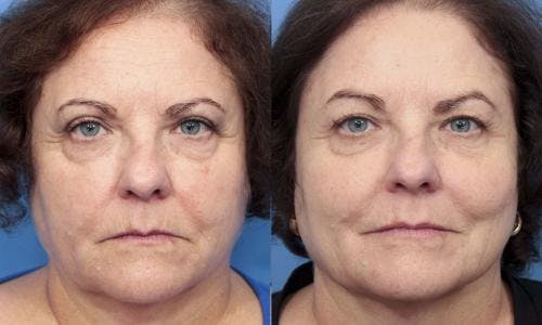 Kybella Before & After Gallery - Patient 58214184 - Image 2