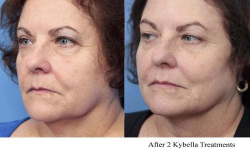 Kybella Before & After Gallery - Patient 58214184 - Image 3