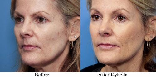 Kybella Before & After Gallery - Patient 58214185 - Image 2