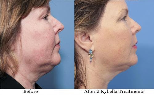 Kybella Before & After Gallery - Patient 58214186 - Image 1