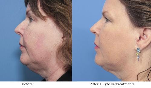 Kybella Before & After Gallery - Patient 58214186 - Image 2