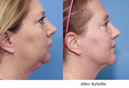 Kybella Before & After Gallery - Patient 58214189 - Image 1