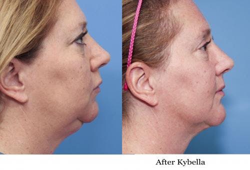Kybella Before & After Gallery - Patient 58214189 - Image 1