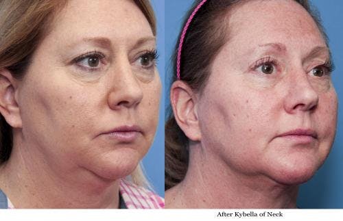 Kybella Before & After Gallery - Patient 58214189 - Image 2