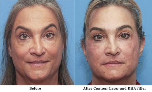 Facial Fillers Before & After Gallery - Patient 58214191 - Image 1