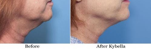 Kybella Before & After Gallery - Patient 58214190 - Image 1