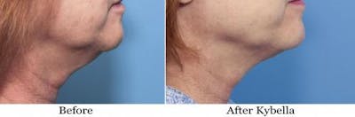 Kybella Before & After Gallery - Patient 58214190 - Image 1