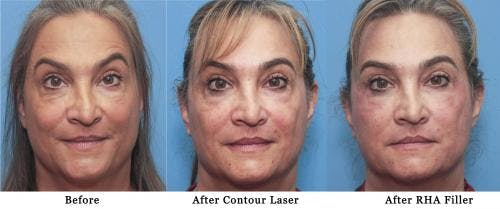 Facial Fillers Before & After Gallery - Patient 58214191 - Image 2