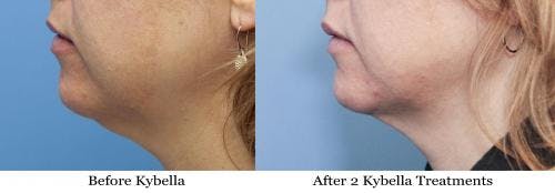 Kybella Before & After Gallery - Patient 58214194 - Image 1