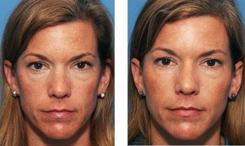 Facial Fillers Before & After Gallery - Patient 58214192 - Image 1