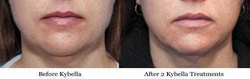 Kybella Before & After Gallery - Patient 58214194 - Image 2