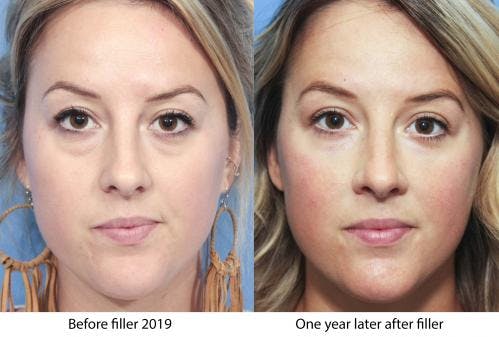 Facial Fillers Before & After Gallery - Patient 58214193 - Image 1