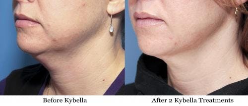 Kybella Before & After Gallery - Patient 58214194 - Image 3