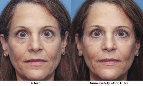 Facial Fillers Before & After Gallery - Patient 58214195 - Image 1