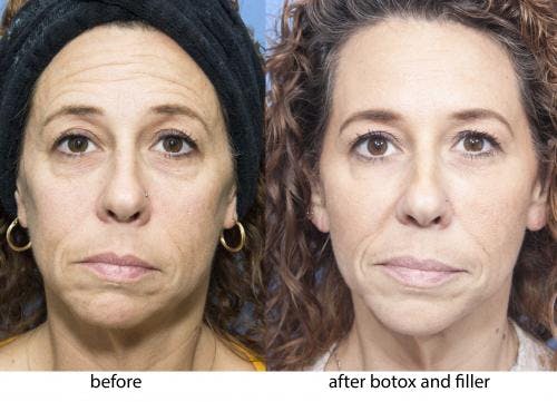 Facial Fillers Before & After Gallery - Patient 58214197 - Image 1