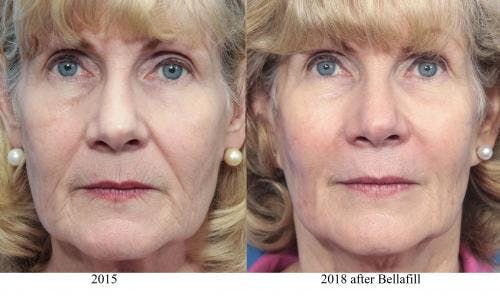 Facial Fillers Before & After Gallery - Patient 58214198 - Image 1