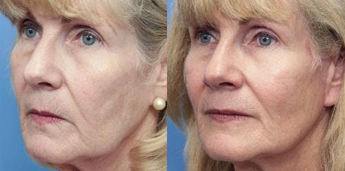 Facial Fillers Before & After Gallery - Patient 58214198 - Image 2