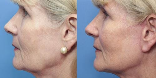 Facial Fillers Before & After Gallery - Patient 58214198 - Image 3