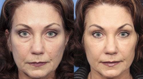 Facial Fillers Before & After Gallery - Patient 58214206 - Image 1